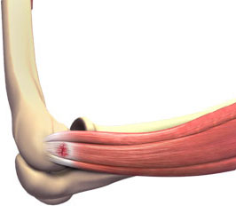 Tennis Elbow Image