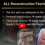 Anterolateral Complex Reconstruction - Rachel M. Frank, MD